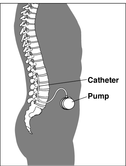 Baclofen Therapy